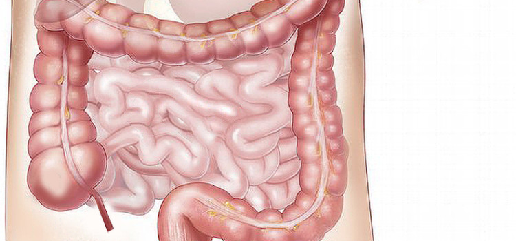 CELIAC DISEASE LINKED TO REFLUX